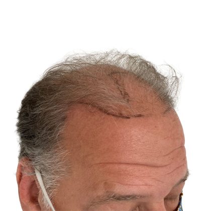 Hair Transplants Before & After Patient #1301