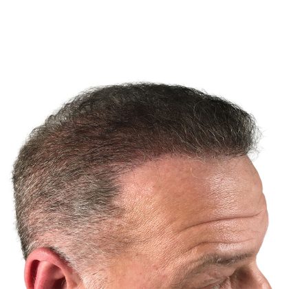 Hair Transplants Before & After Patient #1301