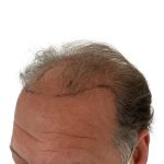 Hair Transplants Before & After Patient #1301