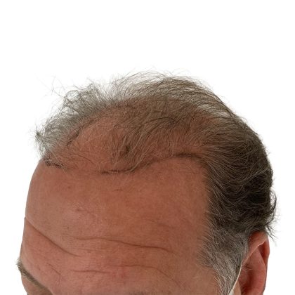 Hair Transplants Before & After Patient #1301