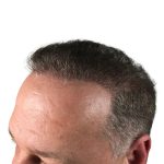 Hair Transplants Before & After Patient #1301