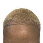 Hair Transplants Before & After Patient #1302