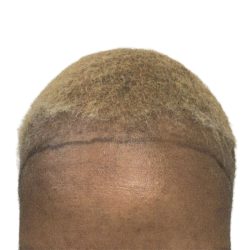 Hair Transplants Before & After Patient #1302