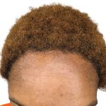 Hair Transplants Before & After Patient #1302