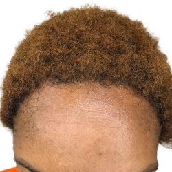 Hair Transplants Before & After Patient #1302
