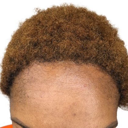 Hair Transplants Before & After Patient #1302