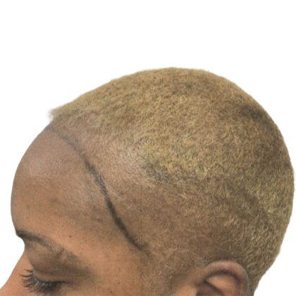 Hair Transplants Before & After Patient #1302