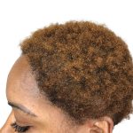 Hair Transplants Before & After Patient #1302