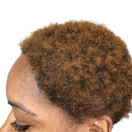 Hair Transplants Before & After Patient #1302