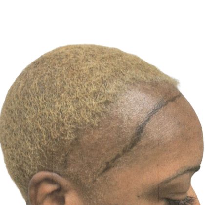 Hair Transplants Before & After Patient #1302