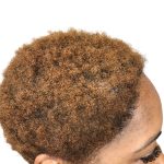 Hair Transplants Before & After Patient #1302