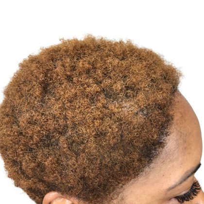 Hair Transplants Before & After Patient #1302