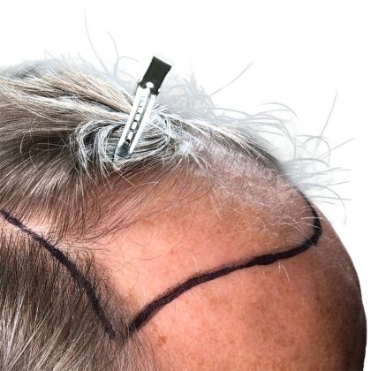 Hair Transplants Before & After Patient #1303
