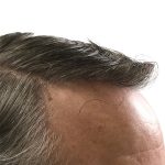 Hair Transplants Before & After Patient #1303
