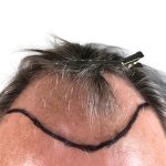 Hair Transplants Before & After Patient #1303