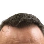 Hair Transplants Before & After Patient #1303