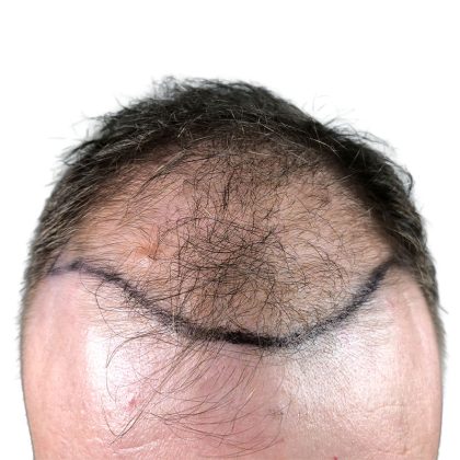 Hair Transplants Before & After Patient #1305