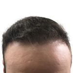 Hair Transplants Before & After Patient #1305