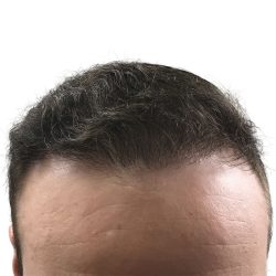 Hair Transplants Before & After Patient #1305