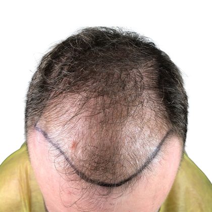 Hair Transplants Before & After Patient #1305