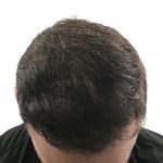 Hair Transplants Before & After Patient #1305