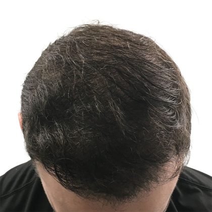 Hair Transplants Before & After Patient #1305