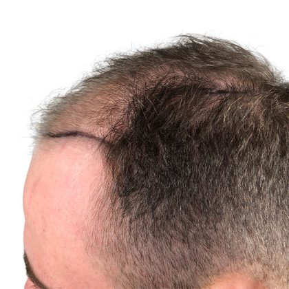 Hair Transplants Before & After Patient #1305