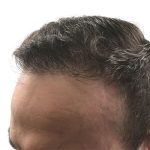 Hair Transplants Before & After Patient #1305