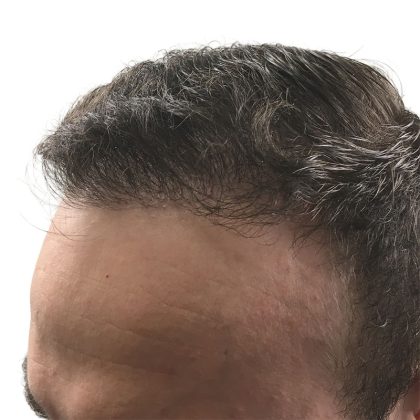 Hair Transplants Before & After Patient #1305