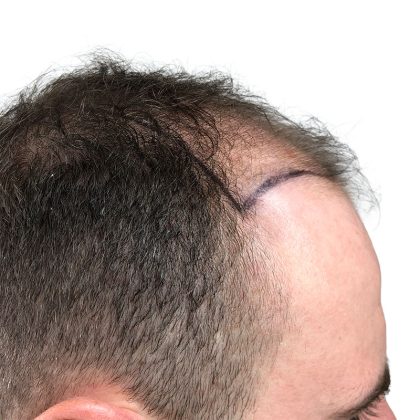 Hair Transplants Before & After Patient #1305