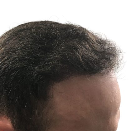 Hair Transplants Before & After Patient #1305