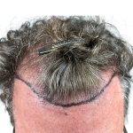 Hair Transplants Before & After Patient #1336