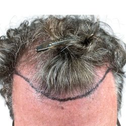 Hair Transplants Before & After Patient #1336