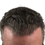 Hair Transplants Before & After Patient #1336