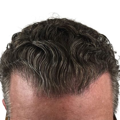 Hair Transplants Before & After Patient #1336