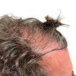 Hair Transplants Before & After Patient #1336