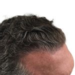 Hair Transplants Before & After Patient #1336