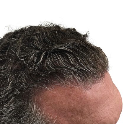Hair Transplants Before & After Patient #1336