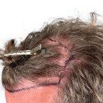 Hair Transplants Before & After Patient #1336