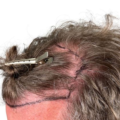 Hair Transplants Before & After Patient #1336