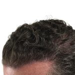 Hair Transplants Before & After Patient #1336