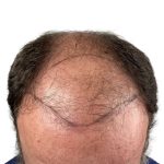 Hair Transplants Before & After Patient #1337