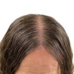 Hair Transplants Before & After Patient #1337