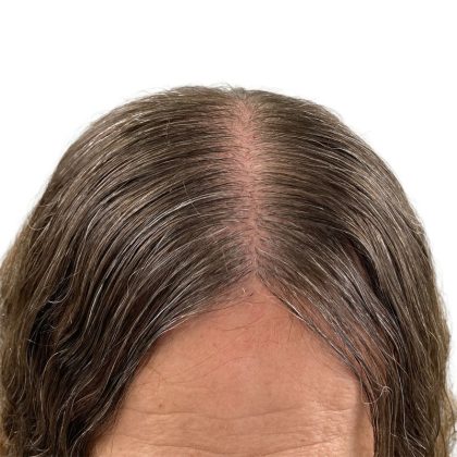 Hair Transplants Before & After Patient #1337