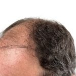 Hair Transplants Before & After Patient #1337
