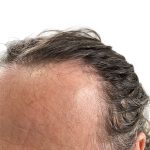Hair Transplants Before & After Patient #1337