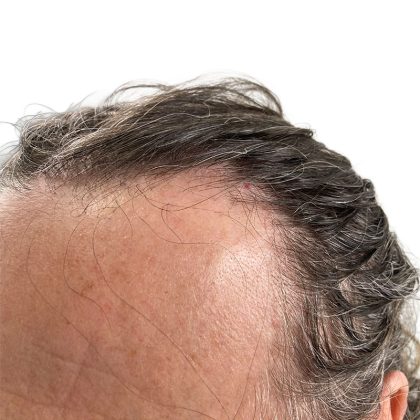 Hair Transplants Before & After Patient #1337