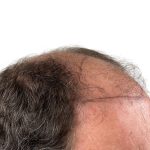 Hair Transplants Before & After Patient #1337