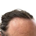 Hair Transplants Before & After Patient #1337
