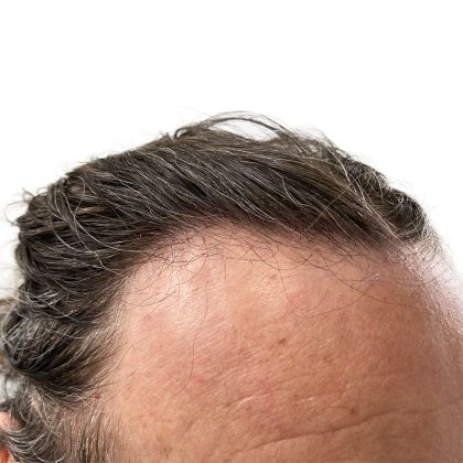 Hair Transplants Before & After Patient #1337